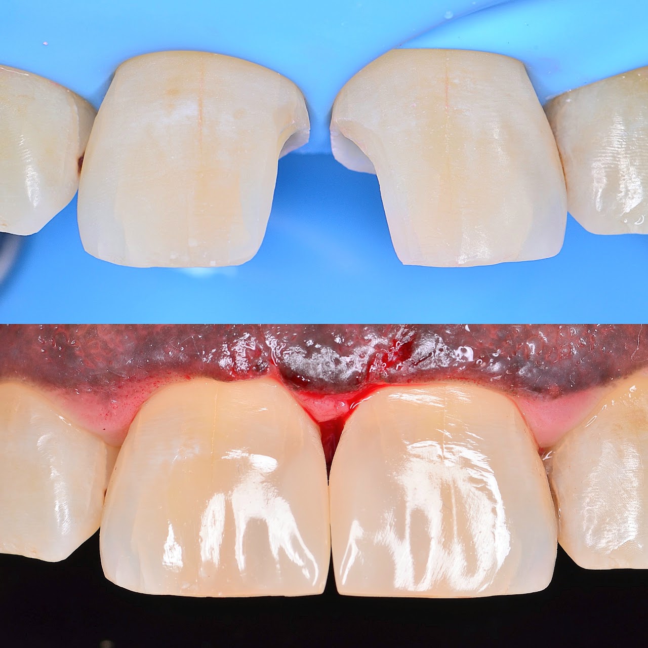 Before and after composite bonding to close a gap