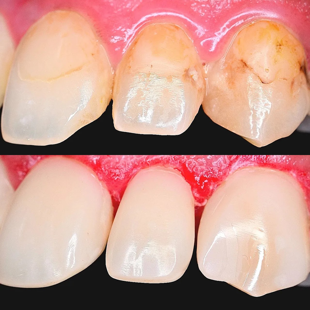 Before and after cosmetic restoration of front teeth