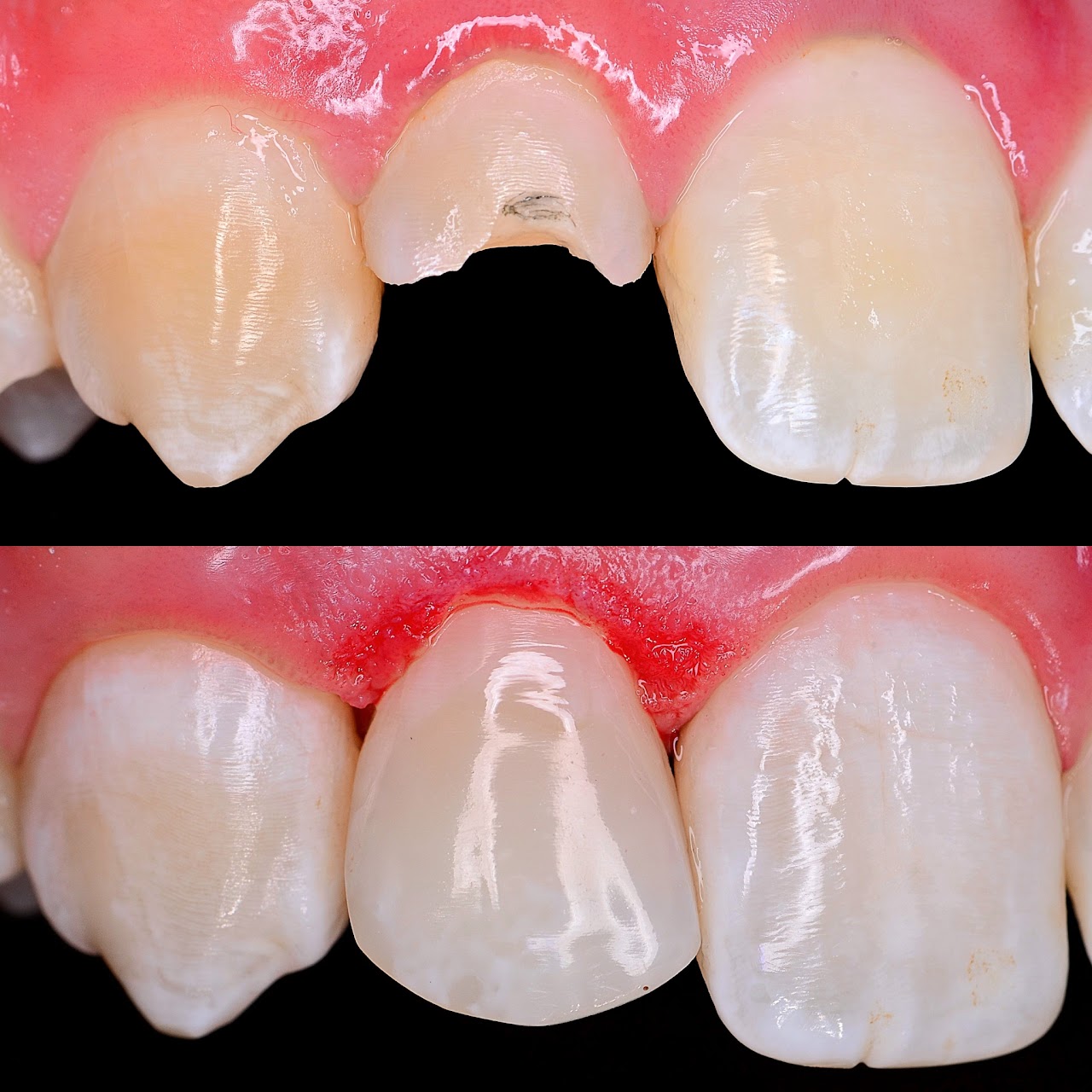 Before and after repair of a chipped front tooth
